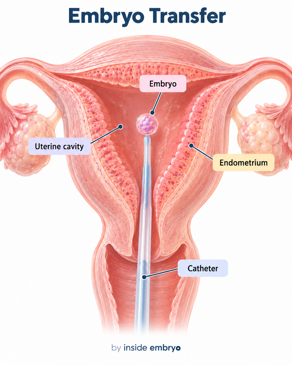 Embryo transfer educational diagram